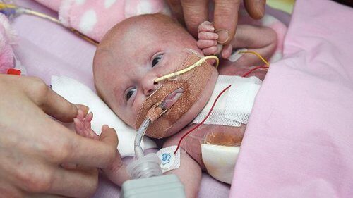 Врачи смогли спасти ребенка, родившегося с сердцем наружу