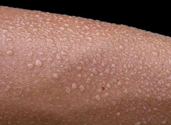 Ученые выяснили, что мужчины чаще женщин страдают от кожных инфекций после тренировок