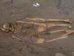 В Перу нашли человеческий скелет с лишними конечностями