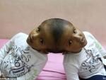 Сиамские близнецы, сросшиеся головами, прибыли на операцию из Бангладеш в Венгрию