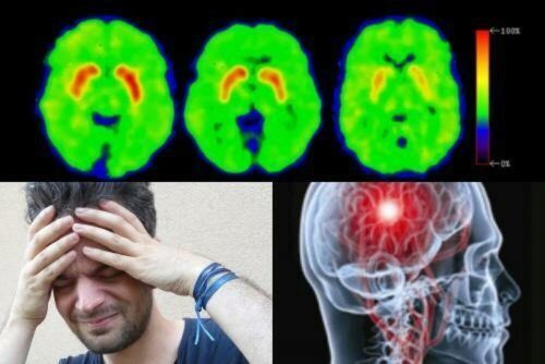 Рак головного мозга имеет свои первые ранние симптомы – Учёные