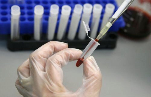 Роспотребнадзор предупредил о вспышке гепатита А в Европе