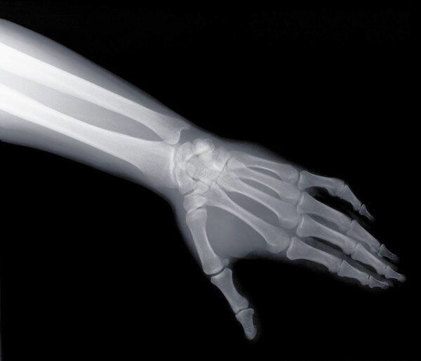 Мужчина без лучевой кости в правой руке живет уже 12 лет в Эвенкии