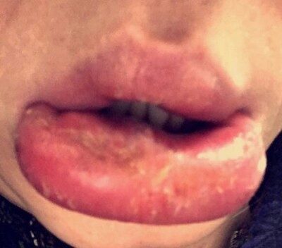 Жительница Уэльса изуродовала себя операцией по увеличению губ