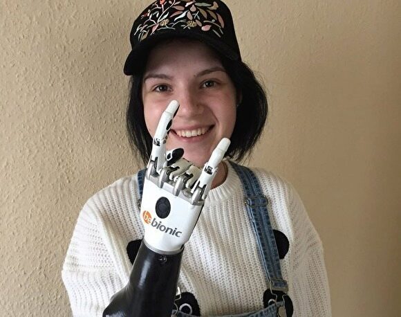 Девушке, которой муж отрубил кисти рук, сделали бионический протез