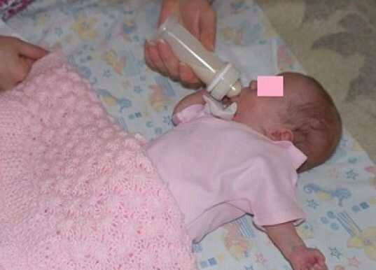 Крошка с ладошку: врачи выходили новорожденную девочку весом 370 граммов