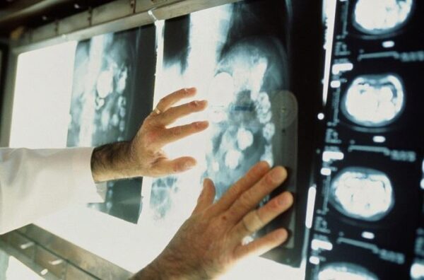 Можно ли заразиться раком: эксперт раскрыл реальные причины онкологических заболеваний