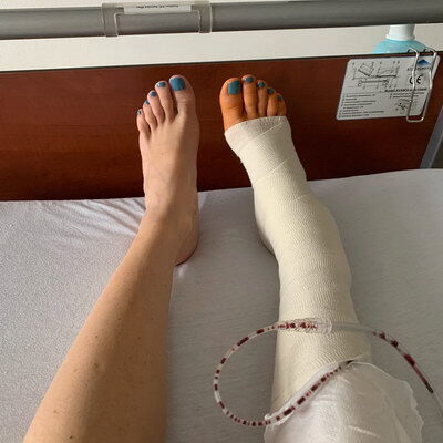 Татьяна Тотьмянина получила в Германии новую ногу