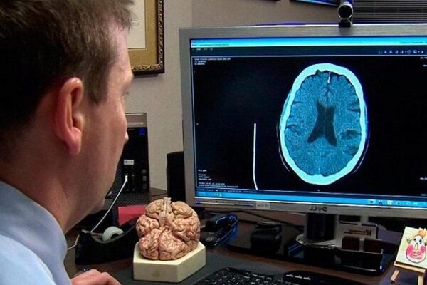 Диетологи назвали продукты, провоцирующие инсульт головного мозга