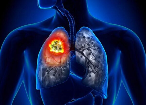 Почему от рака легких умирает все больше некурящих людей, объяснили специалисты