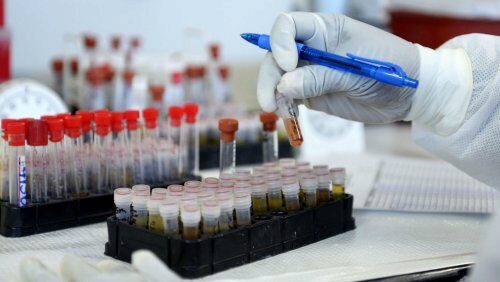 Ученые: Новый способ анализа крови поможет определить слабоумие