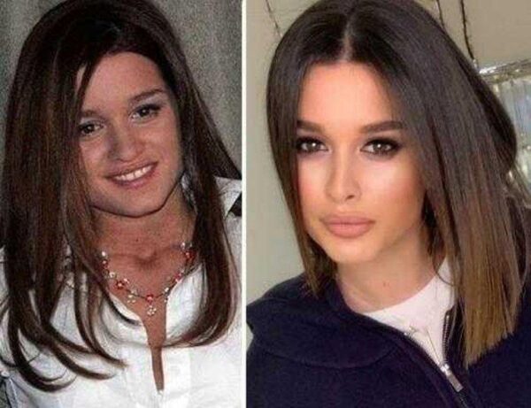Бородина губы до и после фото