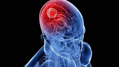 «Рак мозга не имеет симптомов»: Заворотнюк не могла их видеть – Онкологи