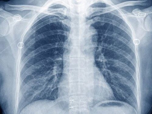 «Без надежды?»: Рентген груди не способен видеть каждый четвёртый рак лёгких