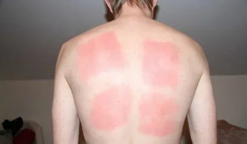 «Бабушкин способ»: Горчичники хорошо помогут при болях в сердце